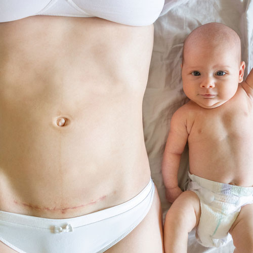 cesarea-intervencion