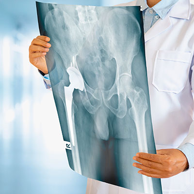 Osteoporosis