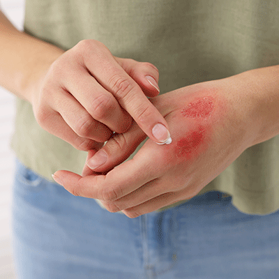 mujer aplicando crema curativa en el interior de la mano quemada