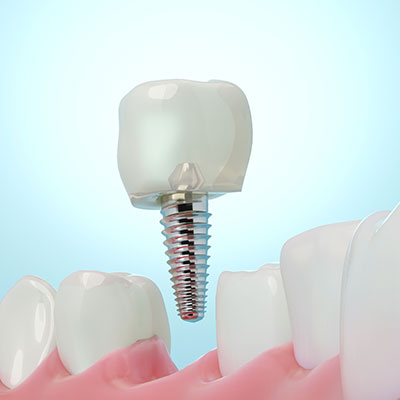 implante de dientes molares