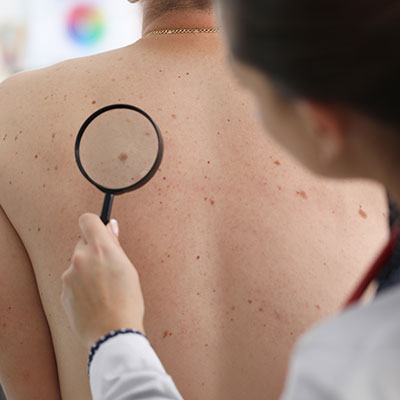 Dermatóloga realiza un examen clínico usando una lupa para detectar posibles síntomas de cáncer de piel en la espalda de un paciente que ha tenido habitos que causan cáncer de piel