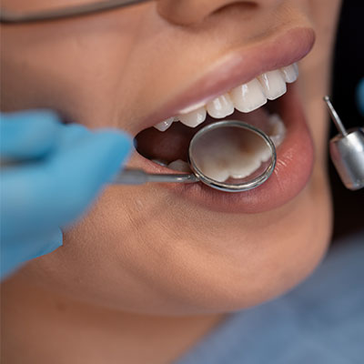hace cuánto no revisas las resina dental